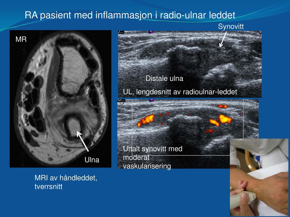 radioulnar-leddet Ulna MRI av håndleddet,