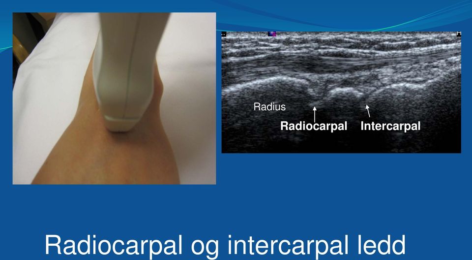 Intercarpal  og