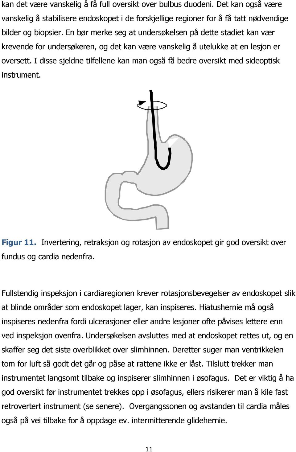 I disse sjeldne tilfellene kan man også få bedre oversikt med sideoptisk instrument. Figur 11. Invertering, retraksjon og rotasjon av endoskopet gir god oversikt over fundus og cardia nedenfra.