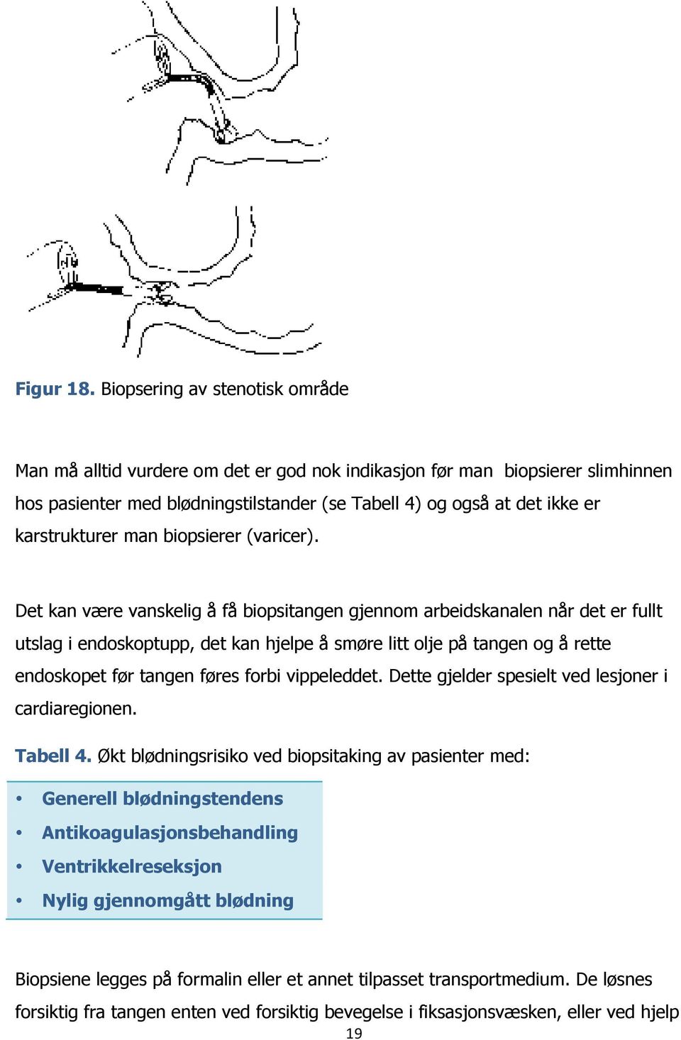 karstrukturer man biopsierer (varicer).