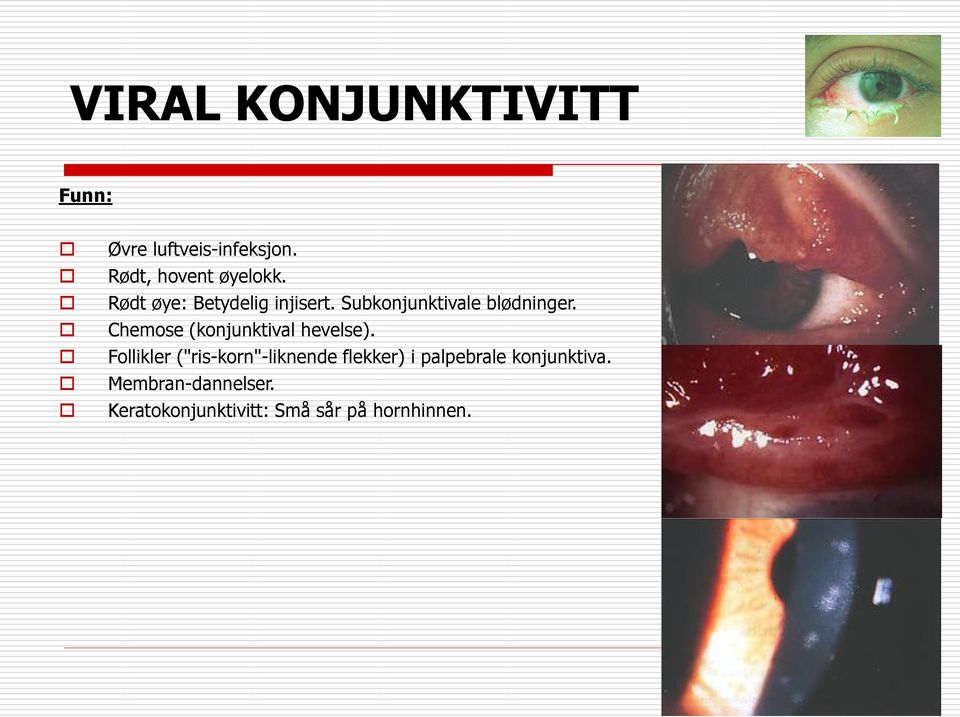 Chemose (konjunktival hevelse).