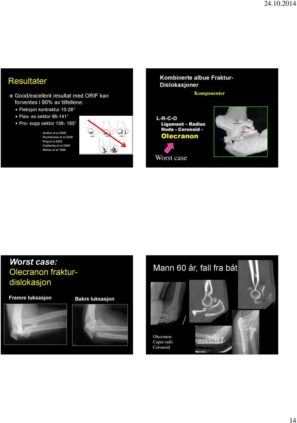 1996 Kombinerte albue Fraktur- Dislokasjoner L-R-C-O Ligament Radius Hode - Coronoid - Olecranon Worst case Komponenter