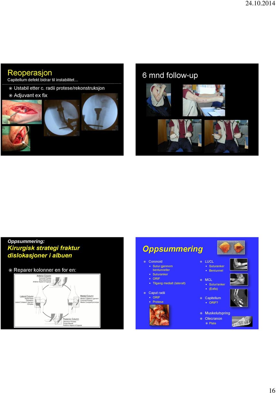 en for en: Fix coronoid Fix/ replace radial head Fix RCLs Fix MCLs Fix olecranon Oppsummering Coronoid Sutur gjennom