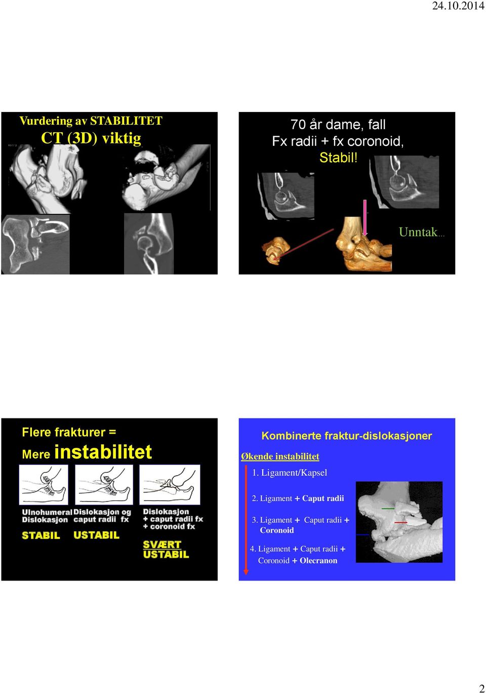 Ligament/Kapsel Ulnohumeral Dislokasjon STABIL Dislokasjon og caput radii fx USTABIL Dislokasjon + caput radii