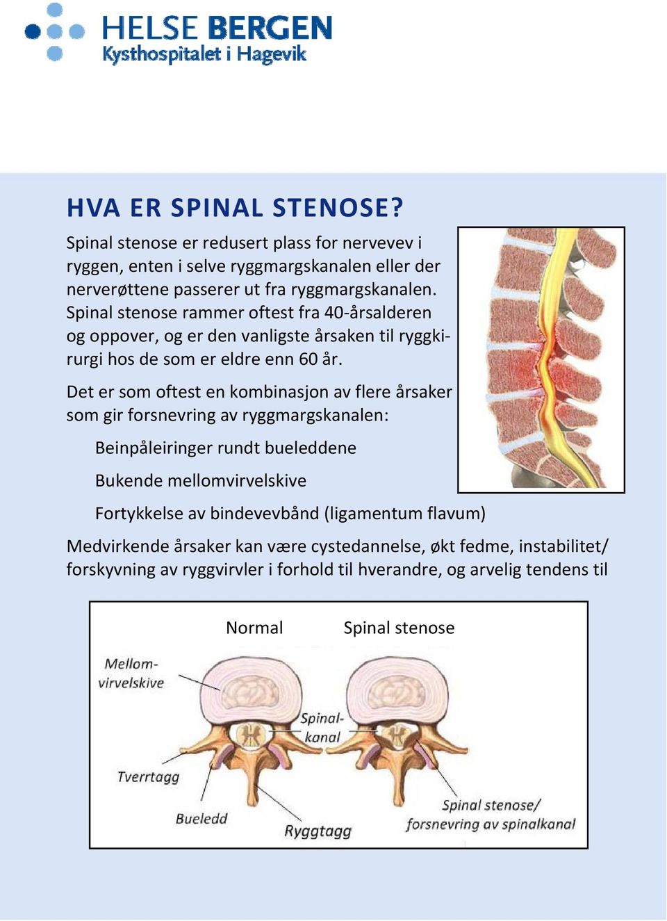 Det er som oftest en kombinasjon av flere årsaker som gir forsnevring av ryggmargskanalen: Beinpåleiringer rundt bueleddene Bukende mellomvirvelskive Fortykkelse av