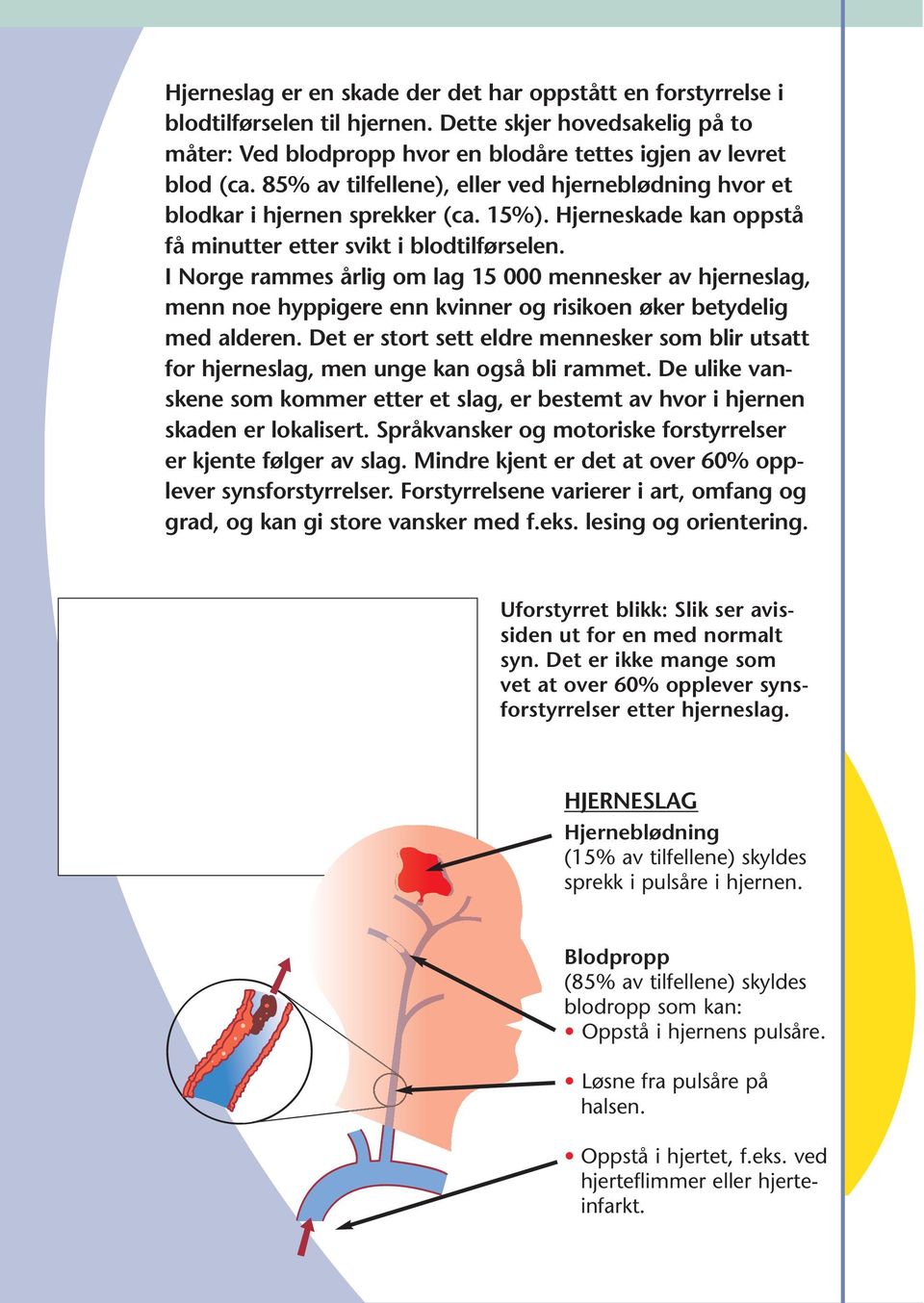 I Norge rammes årlig om lag 15 000 mennesker av hjerneslag, menn noe hyppigere enn kvinner og risikoen øker betydelig med alderen.