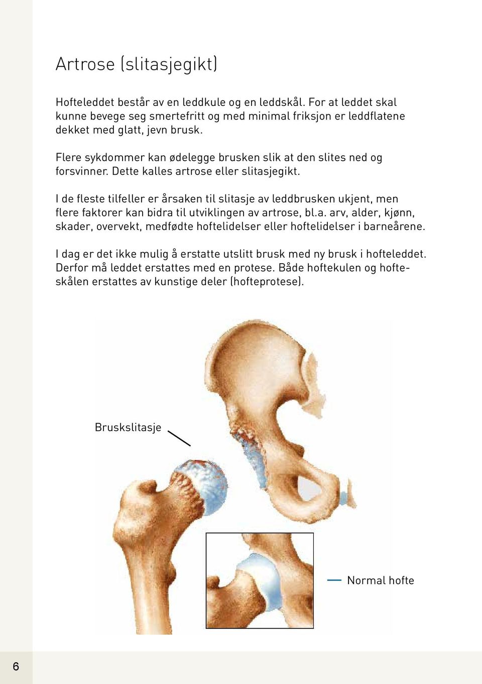 I de fleste tilfeller er årsaken til slitasje av leddbrusken ukjent, men flere faktorer kan bidra til utviklingen av artrose, bl.a. arv, alder, kjønn, skader, overvekt, medfødte hoftelidelser eller hoftelidelser i barneårene.