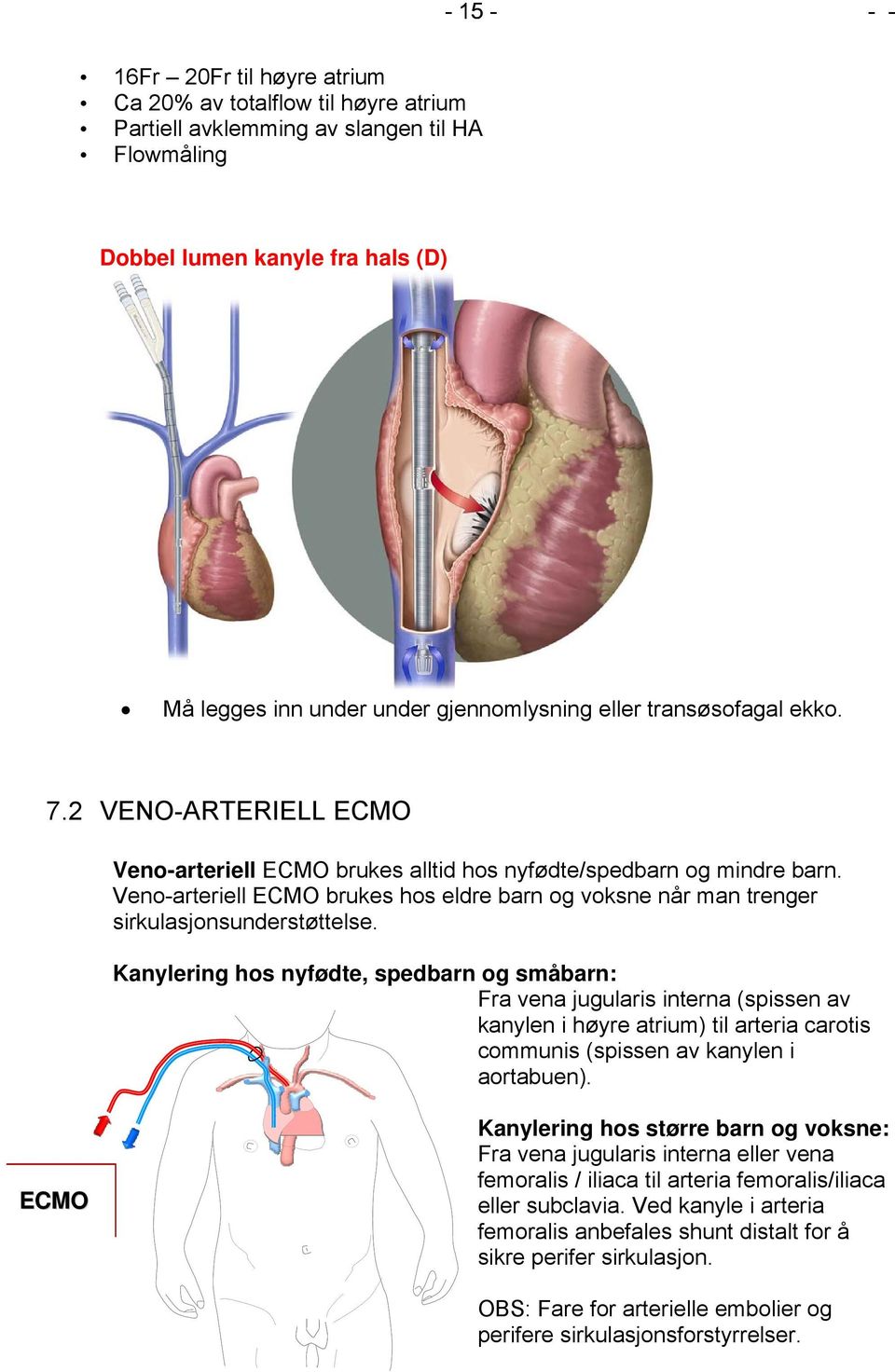 Veno-arteriell ECMO brukes hos eldre barn og voksne når man trenger sirkulasjonsunderstøttelse.
