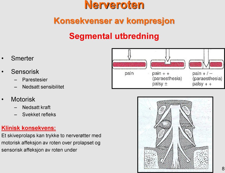 refleks Klinisk konsekvens: Et skiveprolaps kan trykke to nerverøtter med