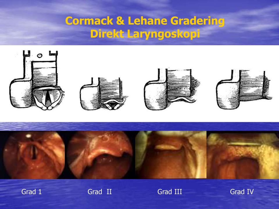 Laryngoskopi Grad 1