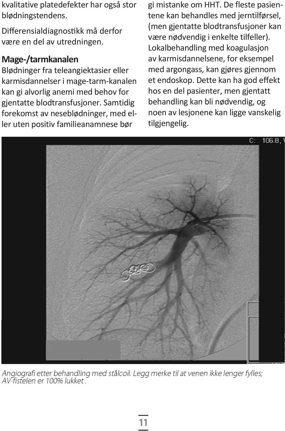 Samtidig forekomst av neseblødninger, med eller uten positiv familie anamnese bør gi mistanke om HHT.