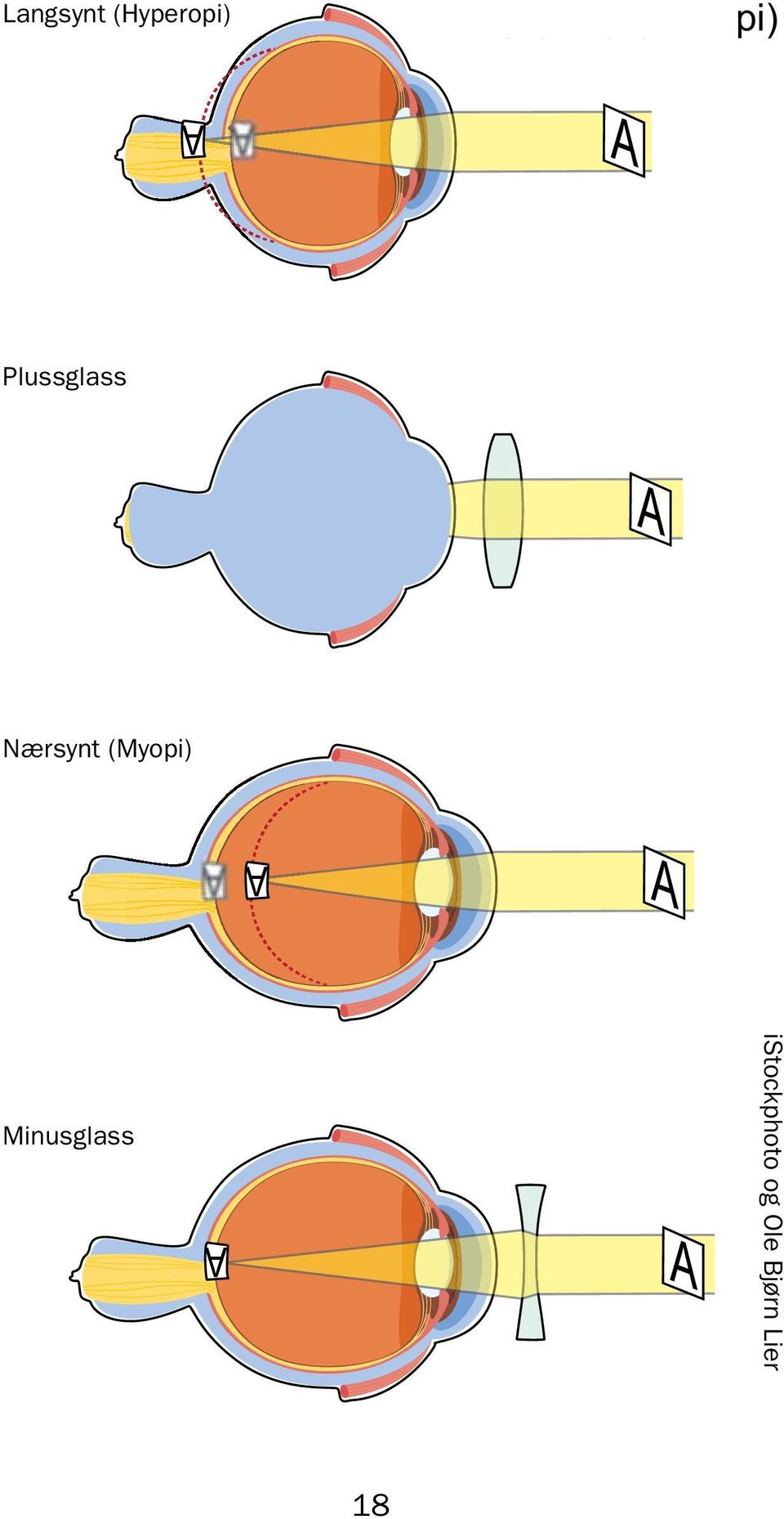 (Myopi) Langsynt (Hyperopi) Nærsynt (Myopi) Minusglass Nærsynt (Myopi)