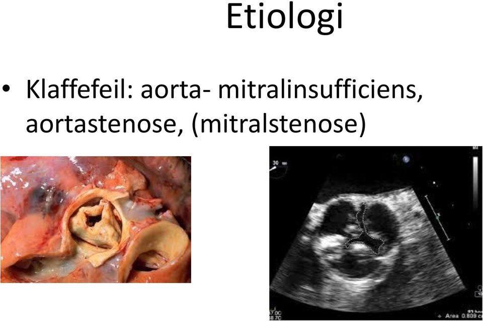 mitralinsufficiens,