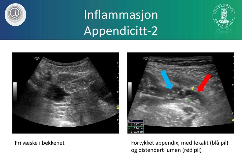 Fortykket appendix, med