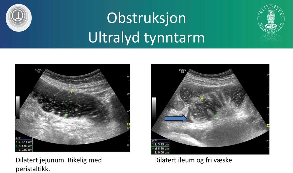 Rikelig med peristaltikk.