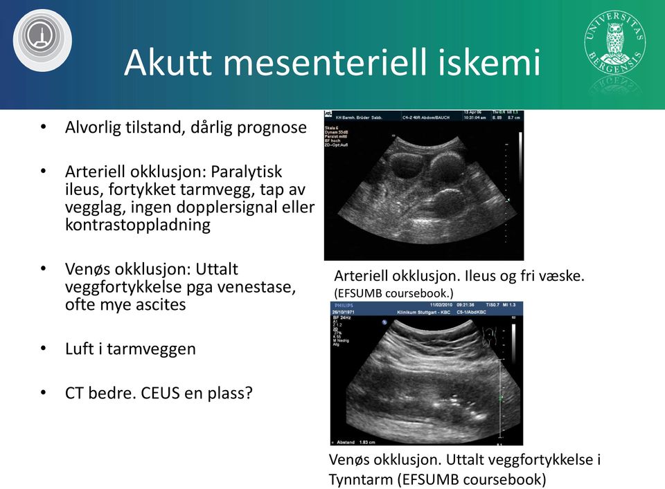 veggfortykkelse pga venestase, ofte mye ascites Arteriell okklusjon. Ileus og fri væske.