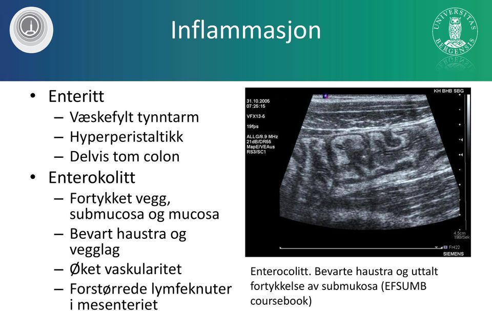 vegglag Øket vaskularitet Forstørrede lymfeknuter i mesenteriet