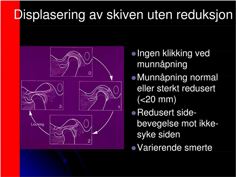 eller sterkt redusert (<20 mm) Redusert side-