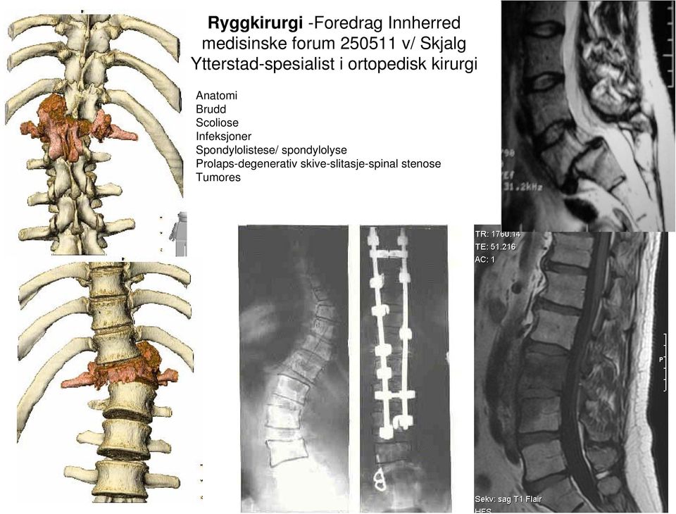 Anatomi Brudd Scoliose Infeksjoner Spondylolistese/