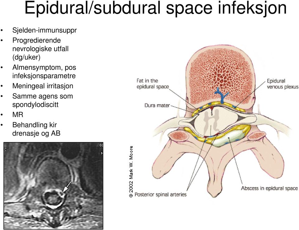 Almensymptom, pos infeksjonsparametre Meningeal