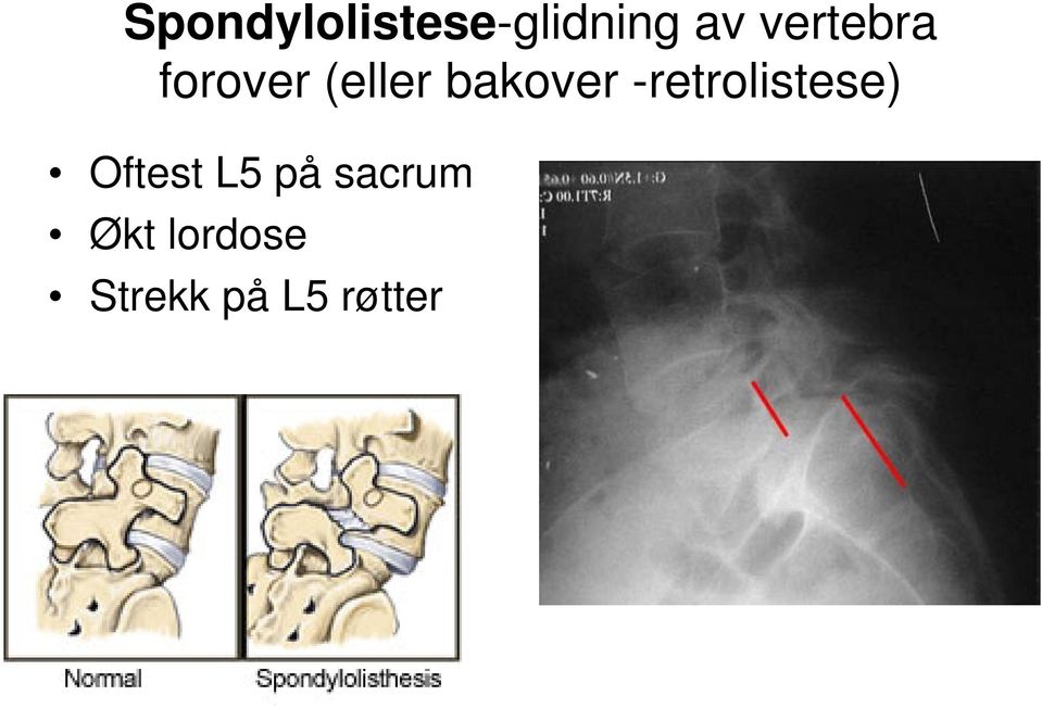 -retrolistese) Oftest L5 på