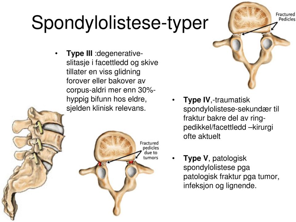 Type IV,-traumatisk spondylolistese-sekundær til fraktur bakre del av ringpedikkel/facettledd kirurgi