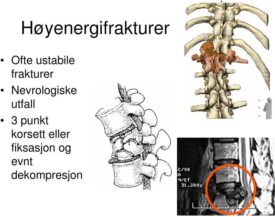 Nevrologiske utfall 3 punkt