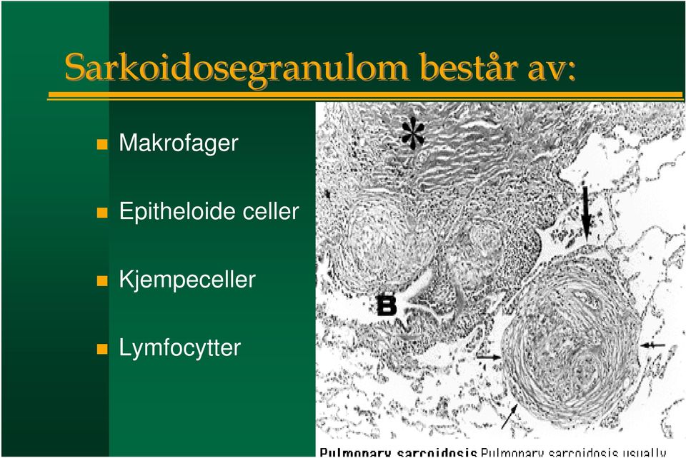 sarcoidosegranulom samme bilde som