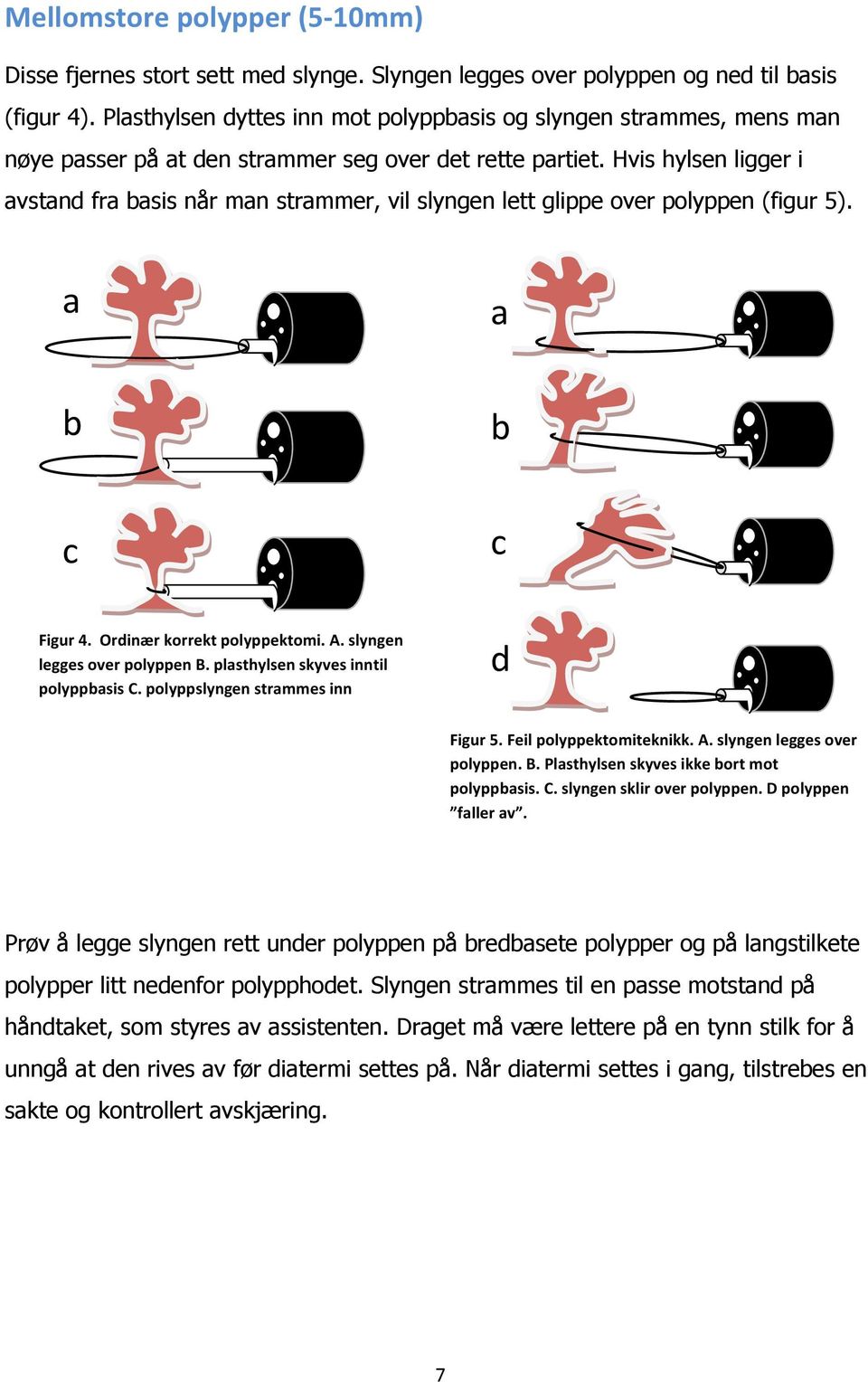 Hvis hylsen ligger i avstand fra basis når man strammer, vil slyngen lett glippe over polyppen (figur 5). a a b b c c Figur 4. Ordinær korrekt polyppektomi. A. slyngen legges over polyppen B.