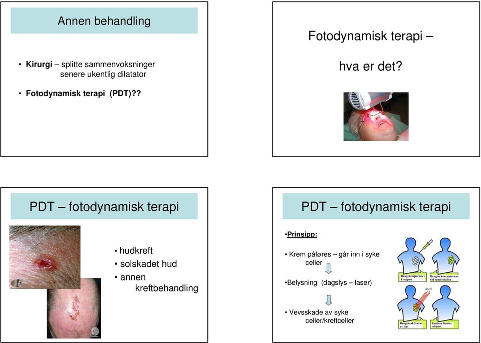 ? PDT fotodynamisk terapi PDT fotodynamisk terapi Prinsipp: hudkreft solskadet hud