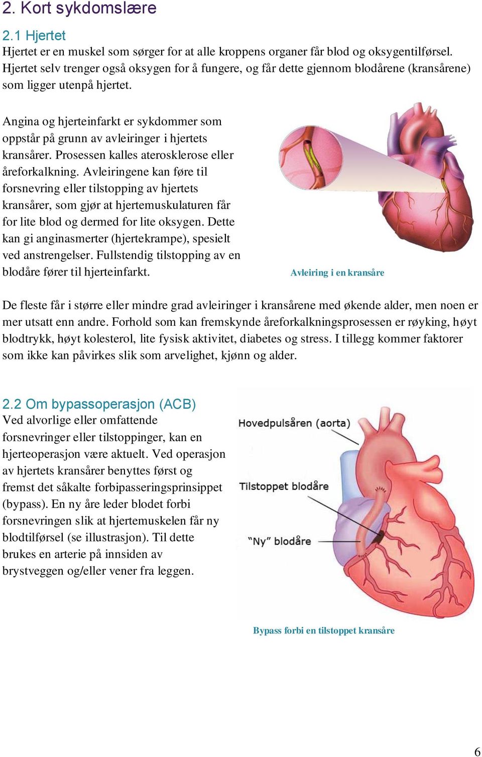 Angina og hjerteinfarkt er sykdommer som oppstår på grunn av avleiringer i hjertets kransårer. Prosessen kalles aterosklerose eller åreforkalkning.