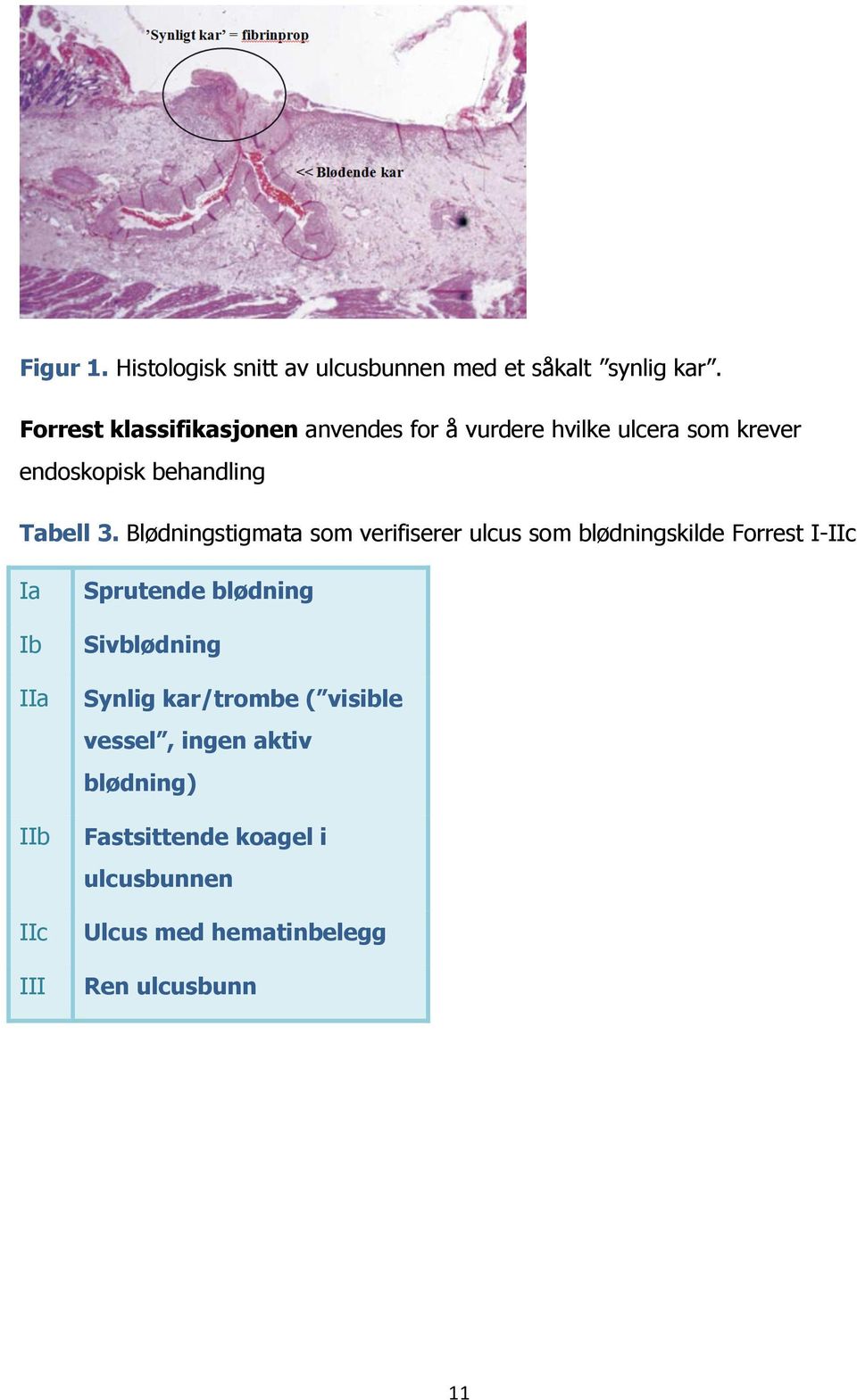 Blødningstigmata som verifiserer ulcus som blødningskilde Forrest I-IIc Ia Sprutende blødning Ib