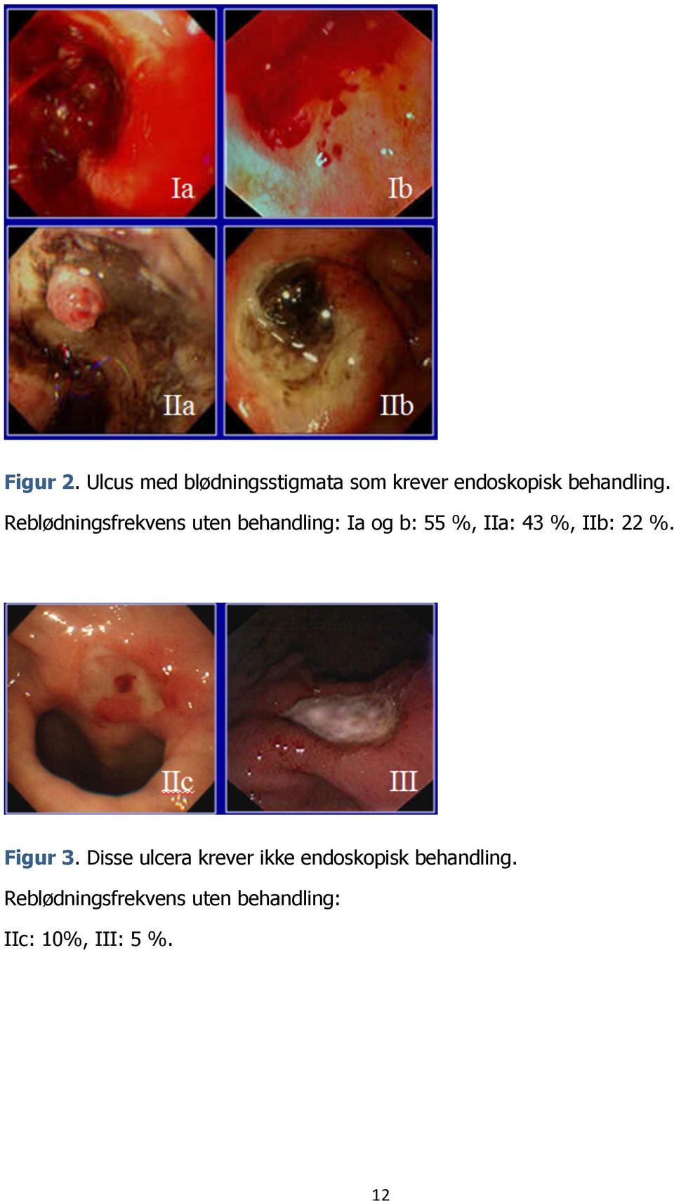 Reblødningsfrekvens uten behandling: Ia og b: 55 %, IIa: 43 %,