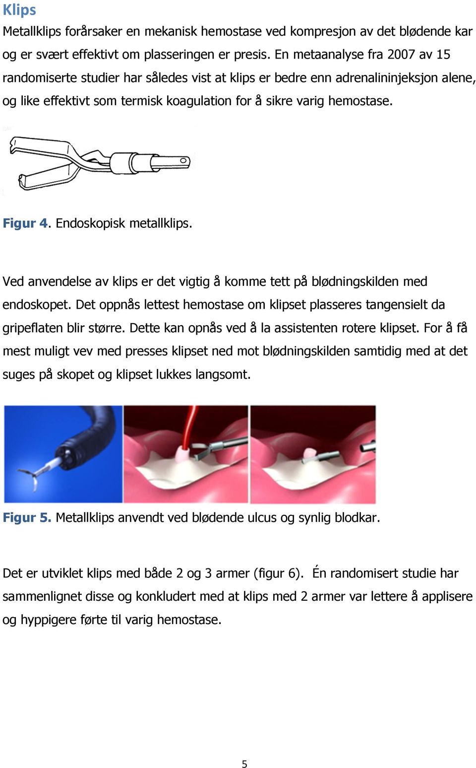 Endoskopisk metallklips. Ved anvendelse av klips er det vigtig å komme tett på blødningskilden med endoskopet. Det oppnås lettest hemostase om klipset plasseres tangensielt da gripeflaten blir større.