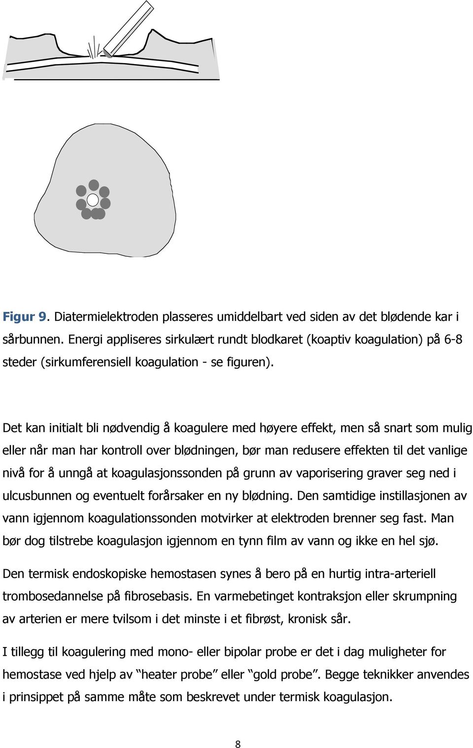 Det kan initialt bli nødvendig å koagulere med høyere effekt, men så snart som mulig eller når man har kontroll over blødningen, bør man redusere effekten til det vanlige nivå for å unngå at