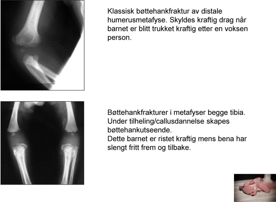 person. Bøttehankfrakturer i metafyser begge tibia.