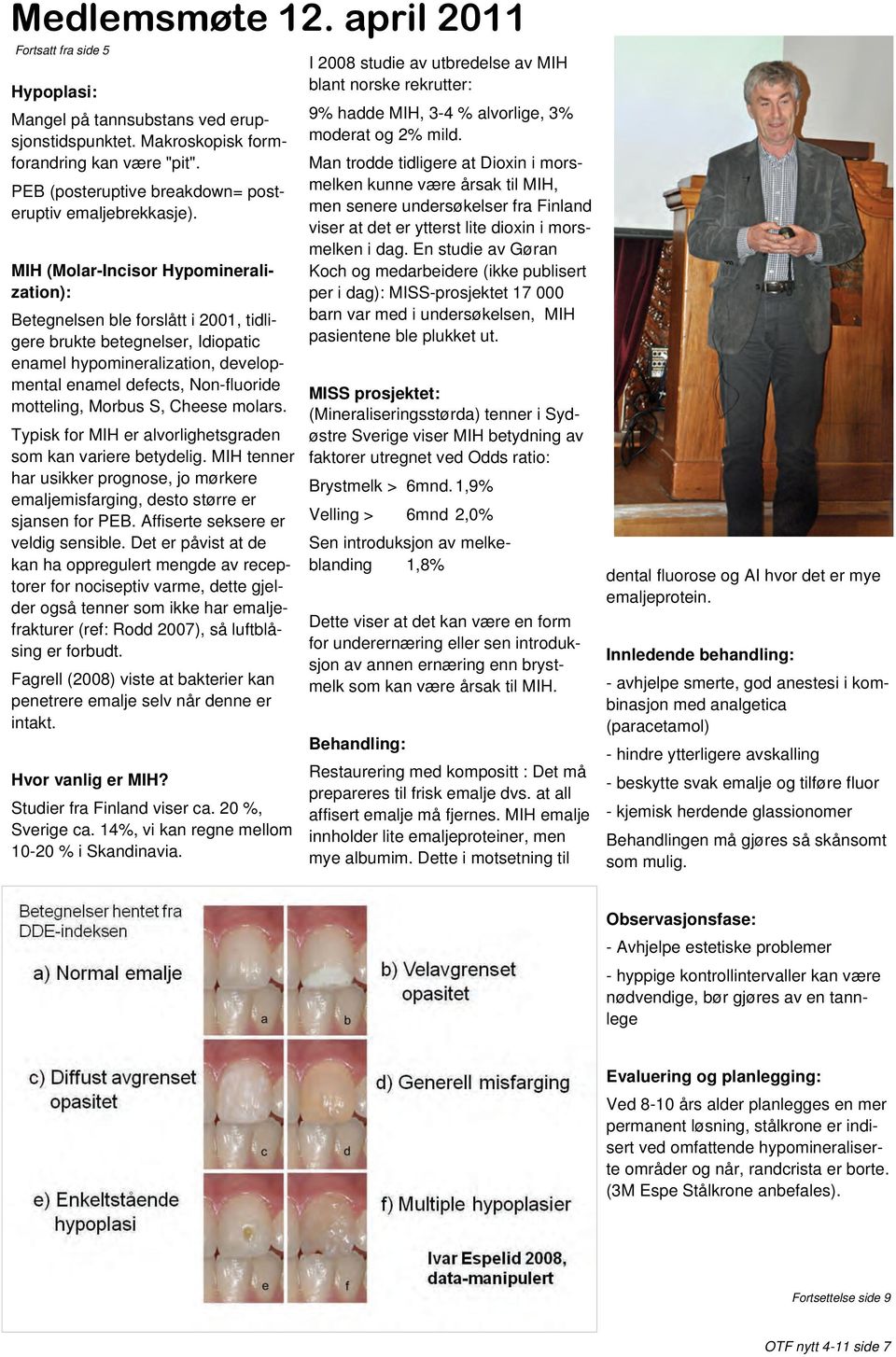 MIH (Molar-Incisor Hypomineralization): Betegnelsen ble forslått i 2001, tidligere brukte betegnelser, Idiopatic enamel hypomineralization, developmental enamel defects, Non-fluoride motteling,