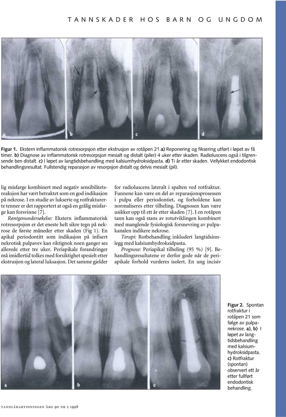 d) Ti år etter skaden. Vellykket endodontisk behandlingsresultat. Fullstendig reparasjon av resorpsjon distalt og delvis mesialt (pil).