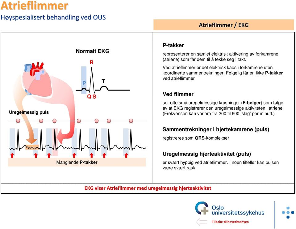 Følgelig får en ikke P-takker ved atrieflimmer Uregelmessig puls Q S Ved flimmer ser ofte små uregelmessige krusninger (F-bølger) som følge av at EKG registrerer den uregelmessige