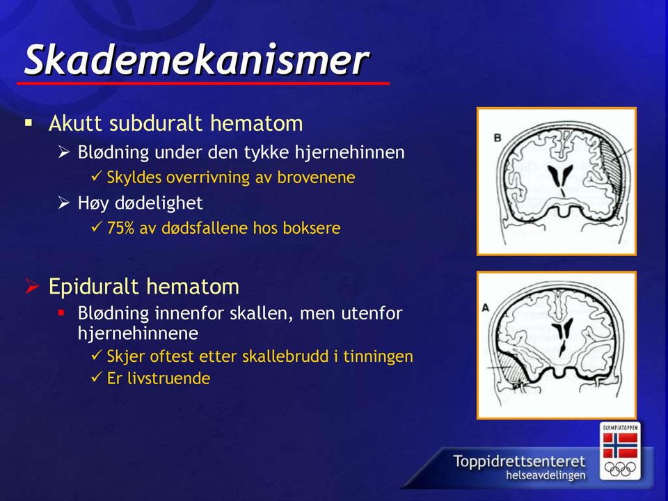 dødsfallene hos boksere Epiduralt hematom Blødning innenfor skallen,