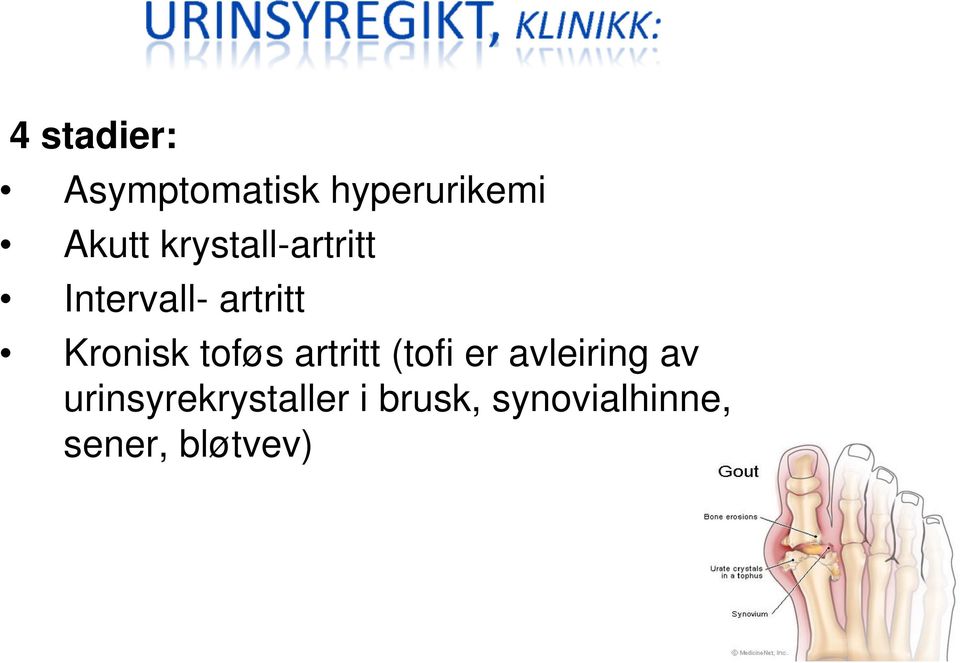 toføs artritt (tofi er avleiring av