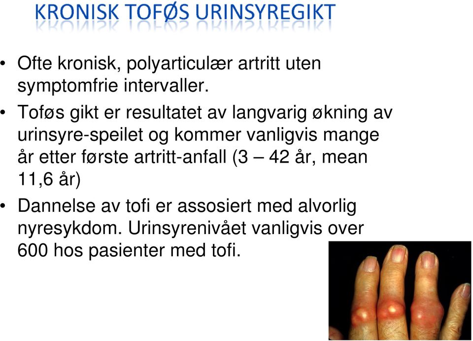 vanligvis mange år etter første artritt-anfall (3 42 år, mean 11,6 år) Dannelse