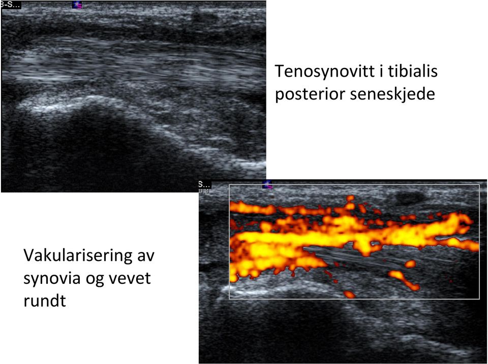 rundt Tenosynovitt i