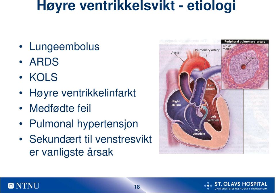 ventrikkelinfarkt Medfødte feil Pulmonal