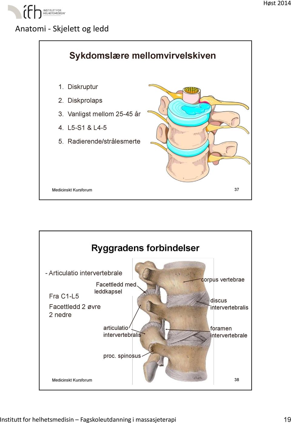 Facettledd 2 øvre 2 nedre Facettledd med leddkapsel articulatio intervertebralis corpus vertebrae discus