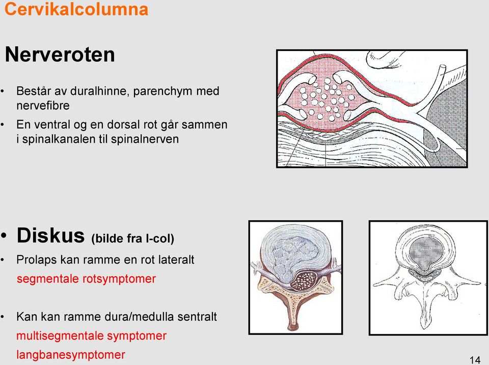 (bilde fra l-col) Prolaps kan ramme en rot lateralt segmentale rotsymptomer