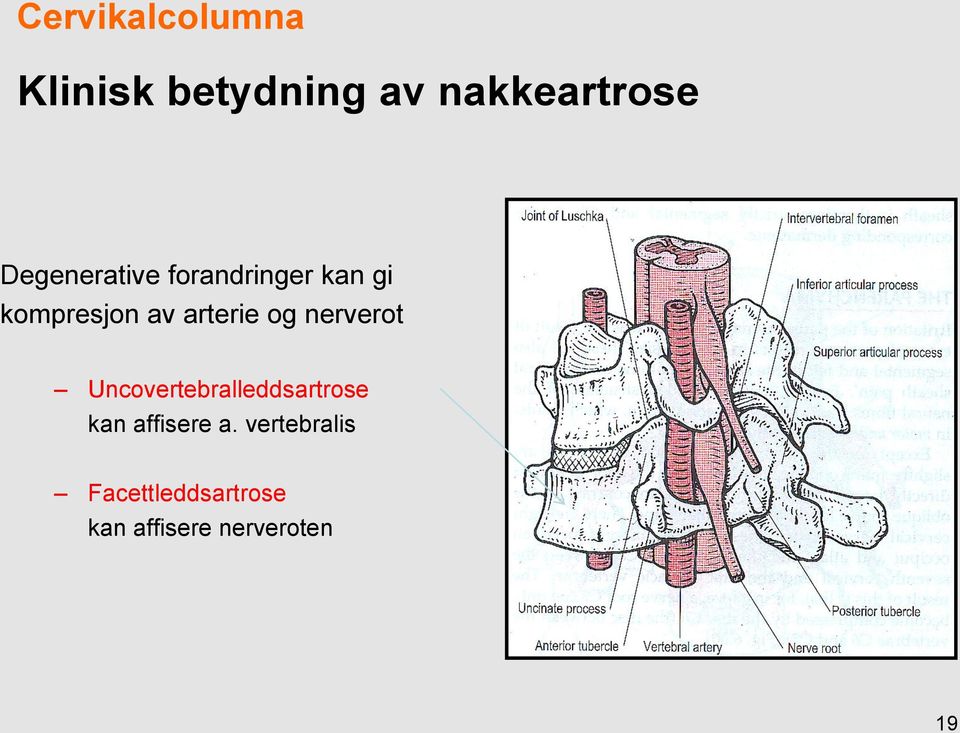 arterie og nerverot Uncovertebralleddsartrose kan