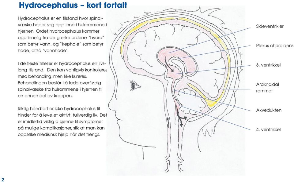 Sideventrikler Plexus choroidens I de fleste tilfeller er hydrocephalus en livslang tilstand. Den kan vanligvis kontrolleres med behandling, men ikke kureres.