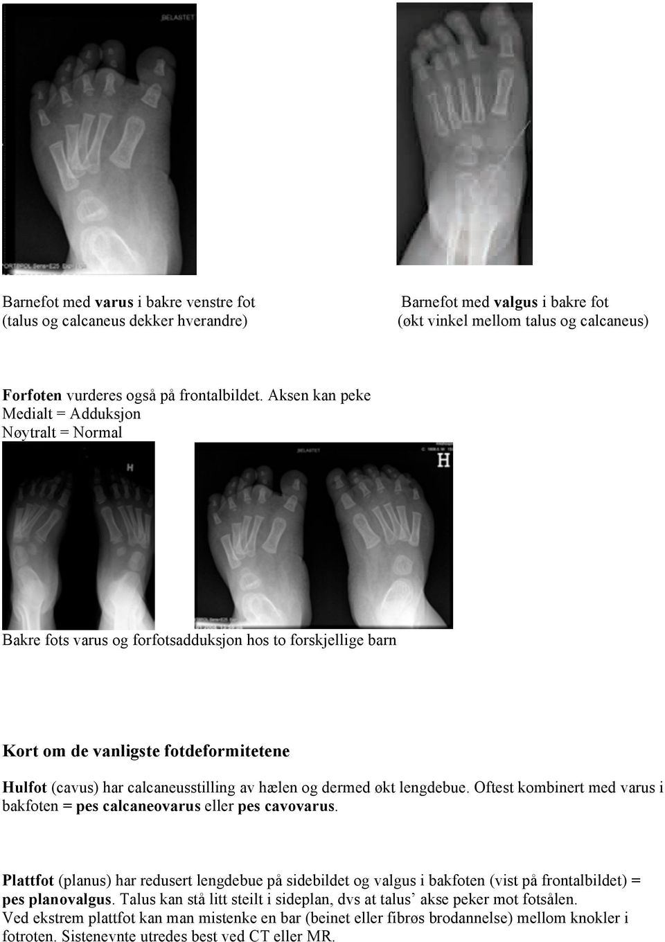 og dermed økt lengdebue. Oftest kombinert med varus i bakfoten = pes calcaneovarus eller pes cavovarus.