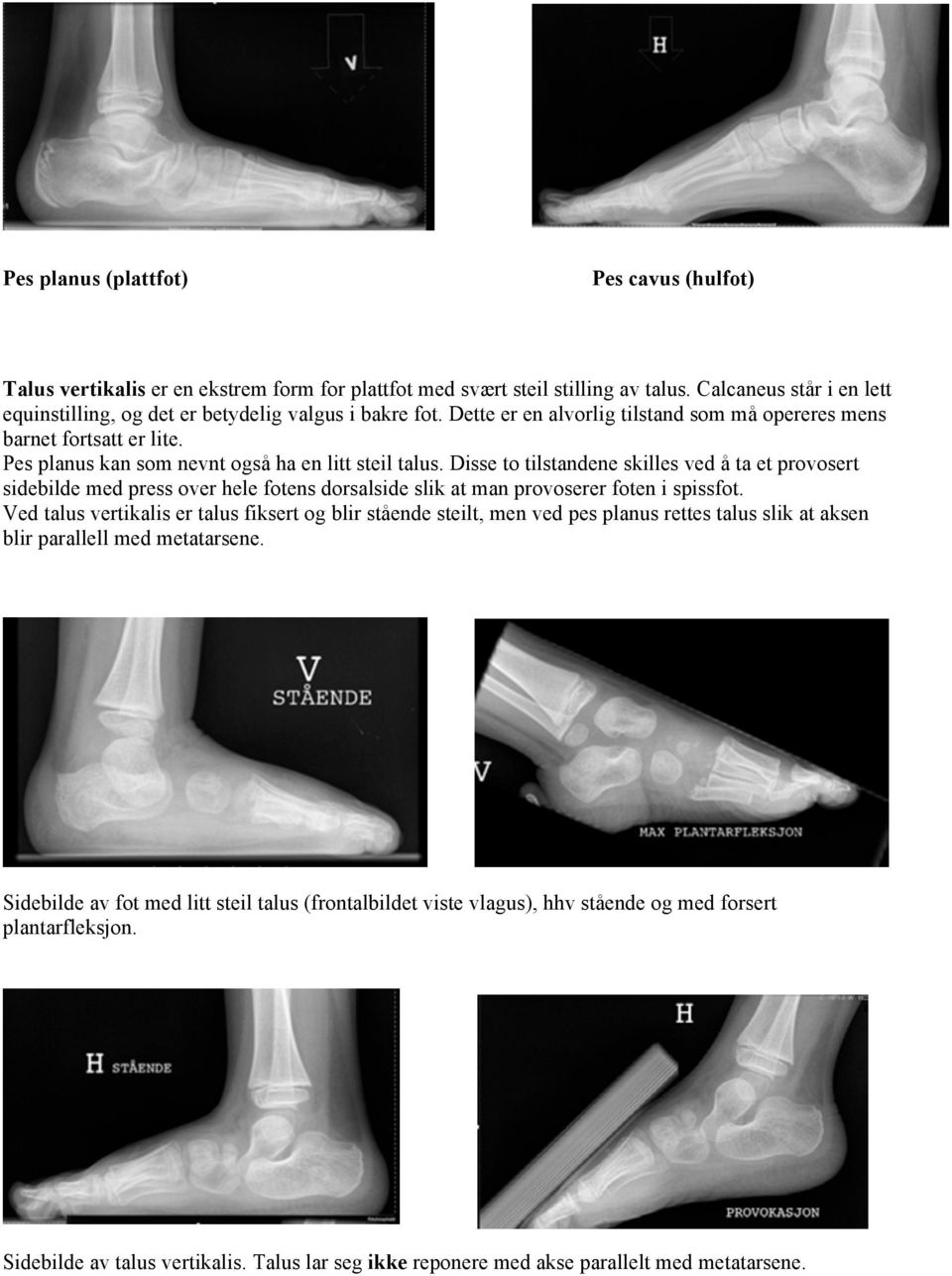 Pes planus kan som nevnt også ha en litt steil talus. Disse to tilstandene skilles ved å ta et provosert sidebilde med press over hele fotens dorsalside slik at man provoserer foten i spissfot.